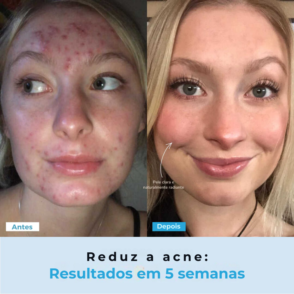 BelGlow Pro + Serum Grátis