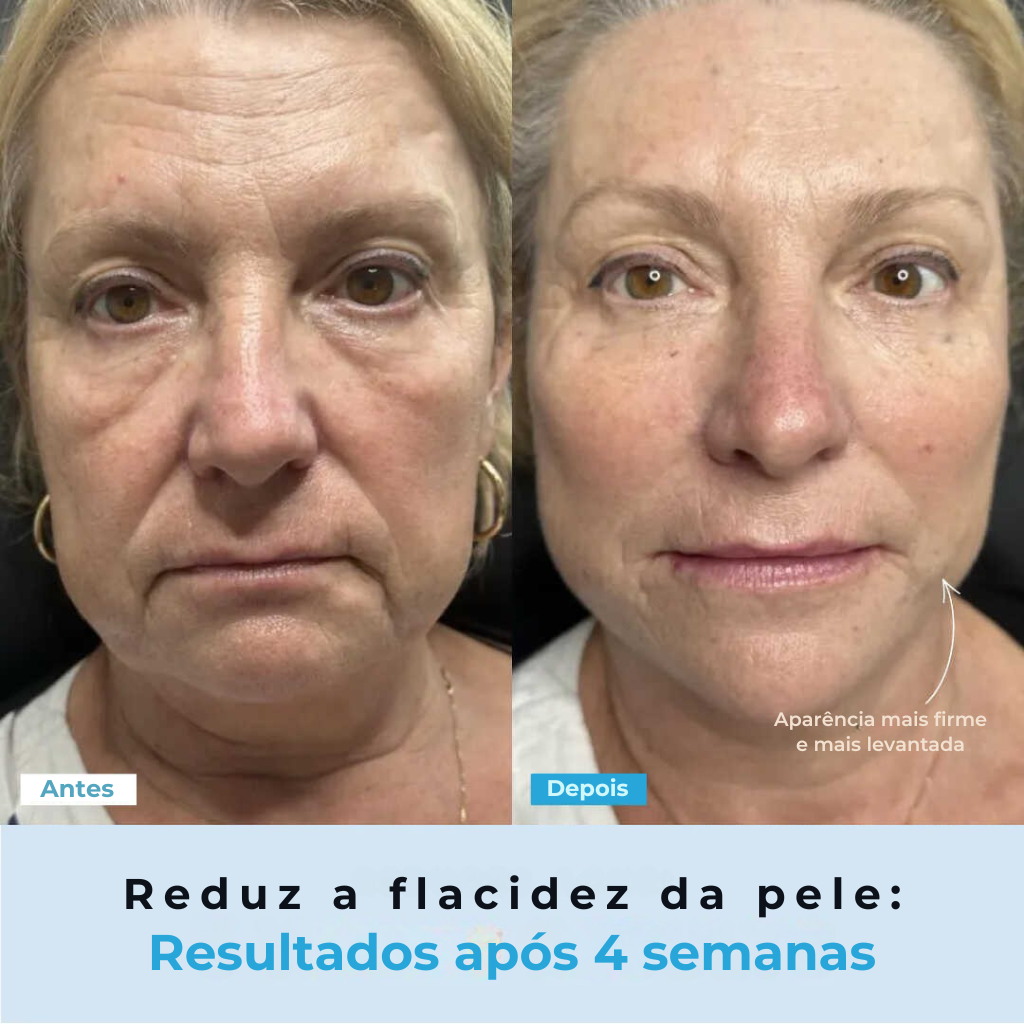 BelGlow Pro + Serum Grátis